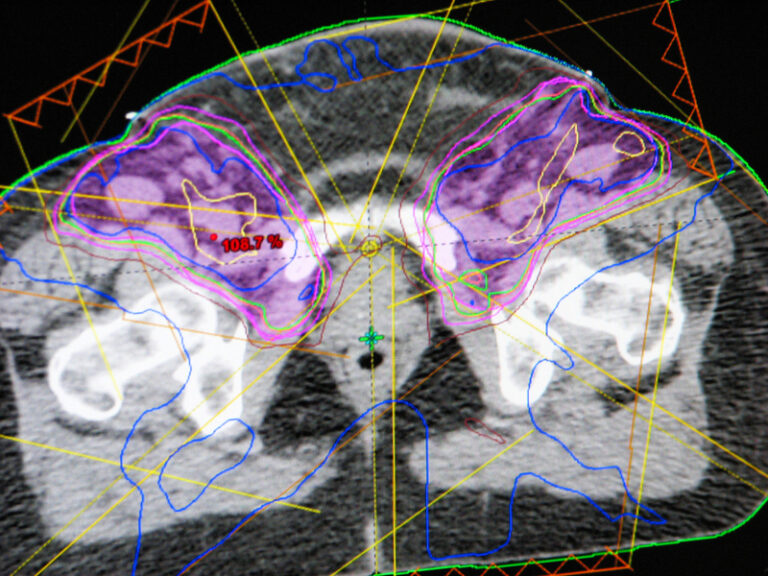 Precise treatment planning and dosimetry ensure effective, safe radiation therapy