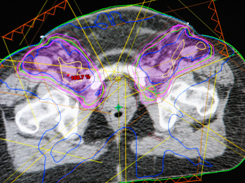 Precise treatment planning and dosimetry ensure effective, safe radiation therapy
