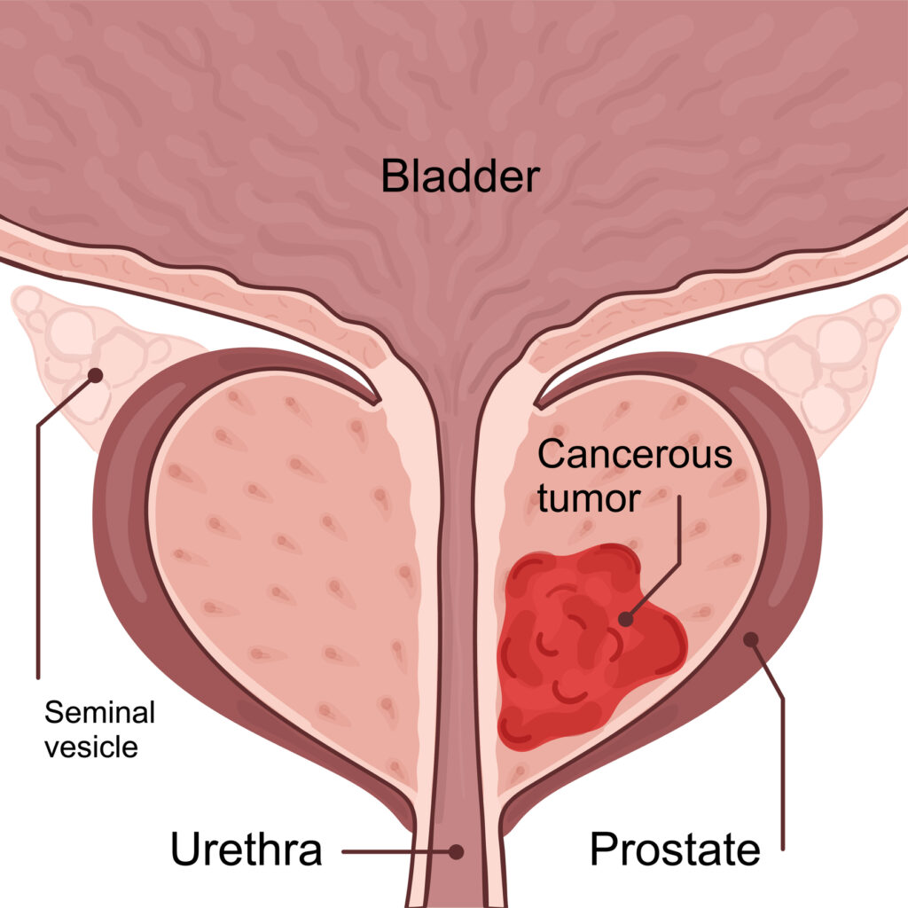 Actinium-225 DOTAZOL targets bone diseases, focusing on prostate cancer treatment