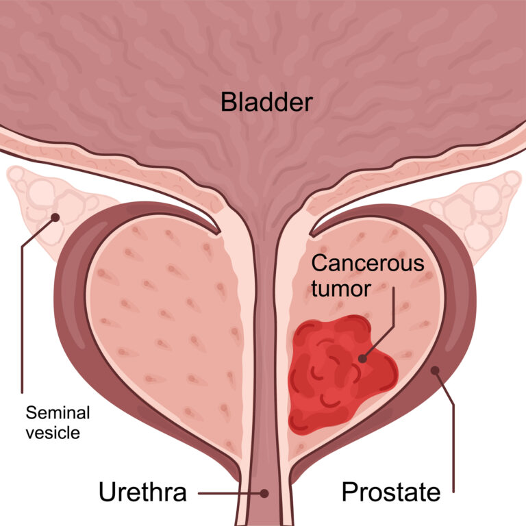 Actinium-225 DOTAZOL targets bone diseases, focusing on prostate cancer treatment