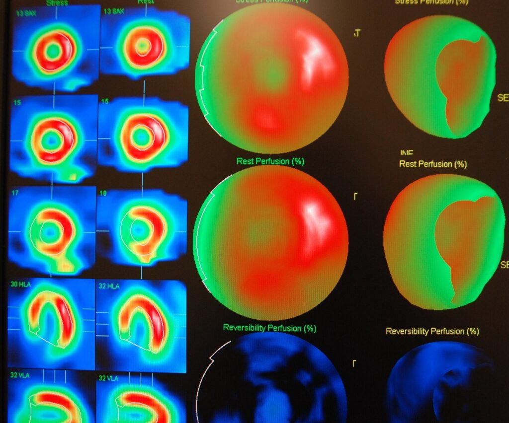 SPECT imaging enhances myocardial perfusion analysis and brain disorder diagnostics accuracy