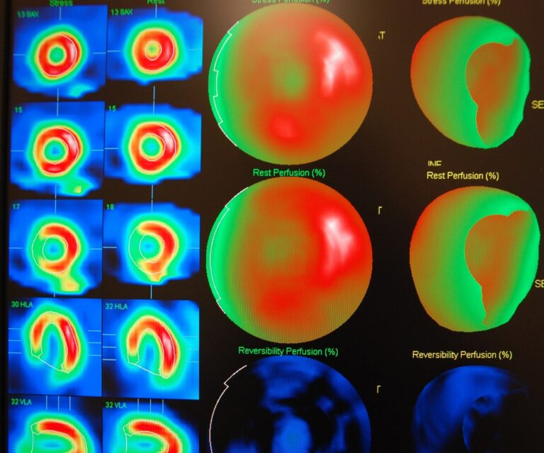 SPECT imaging enhances myocardial perfusion analysis and brain disorder diagnostics accuracy