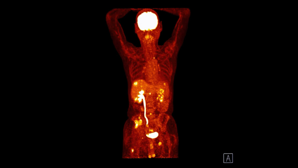 Total Body PET systems enable faster, whole-body imaging with sensitivity
