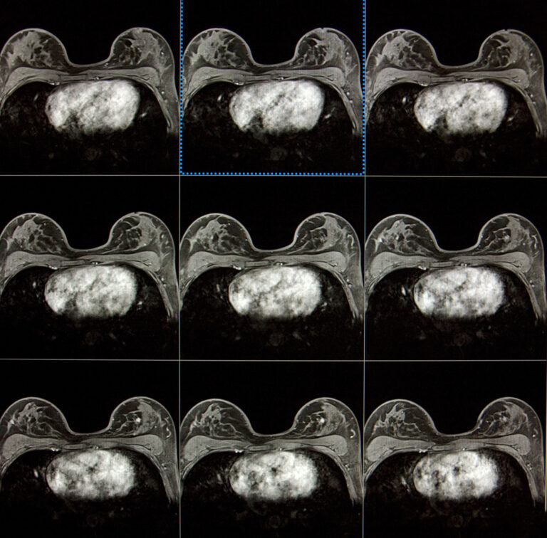 Advanced imaging and targeted therapies are transforming breast cancer diagnosis, treatment
