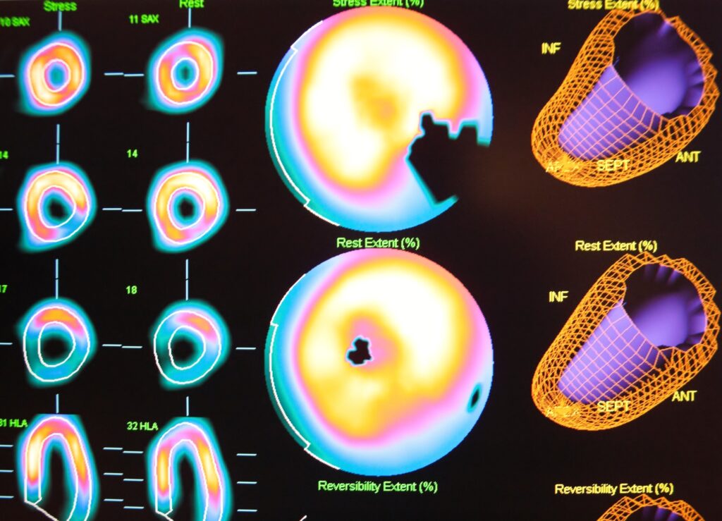 SPECT Imaging Myocardial perfusion imaging helps identify coronary artery disease with accuracy