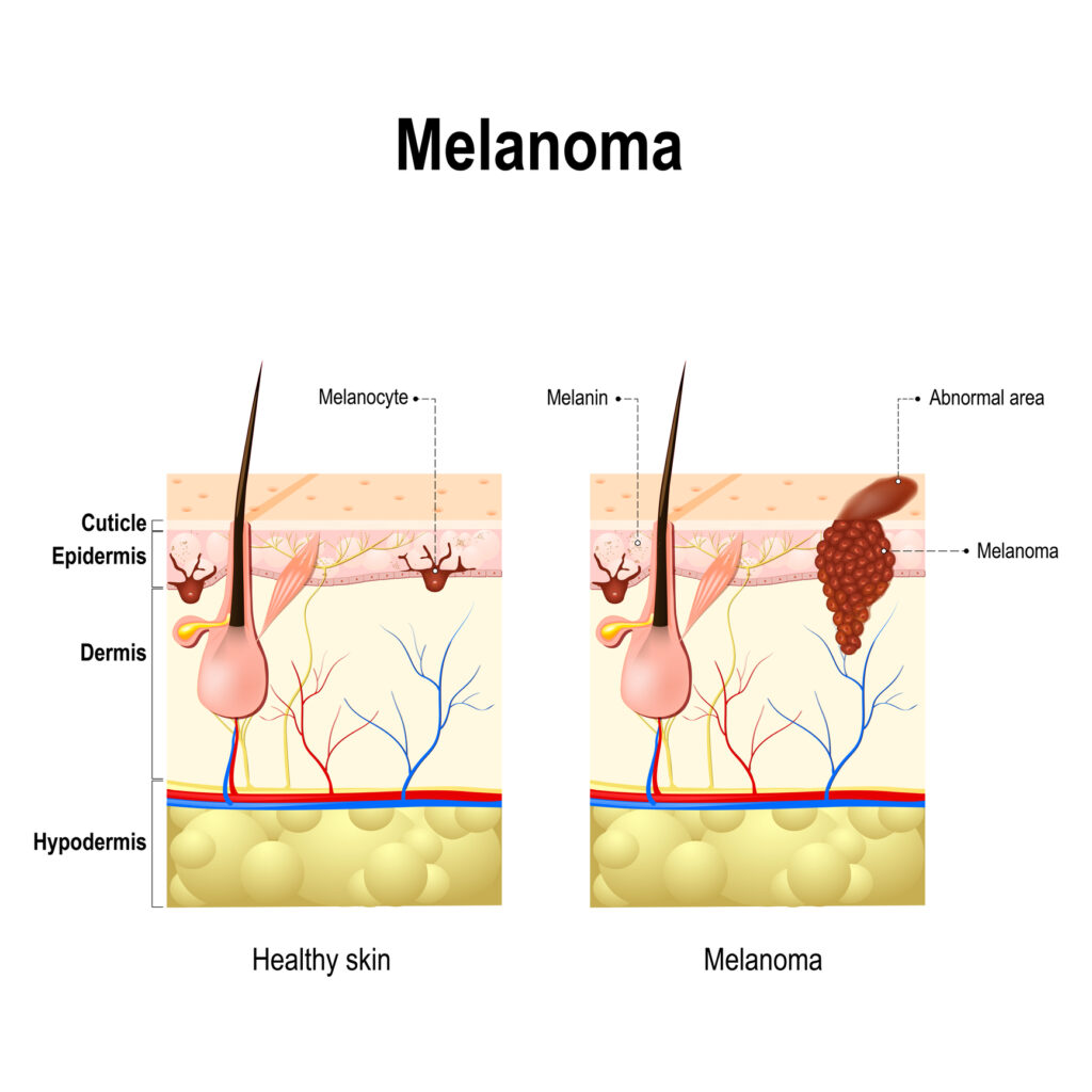 Targeted uveal melanoma treatment delivers precision therapy with minimal side effects