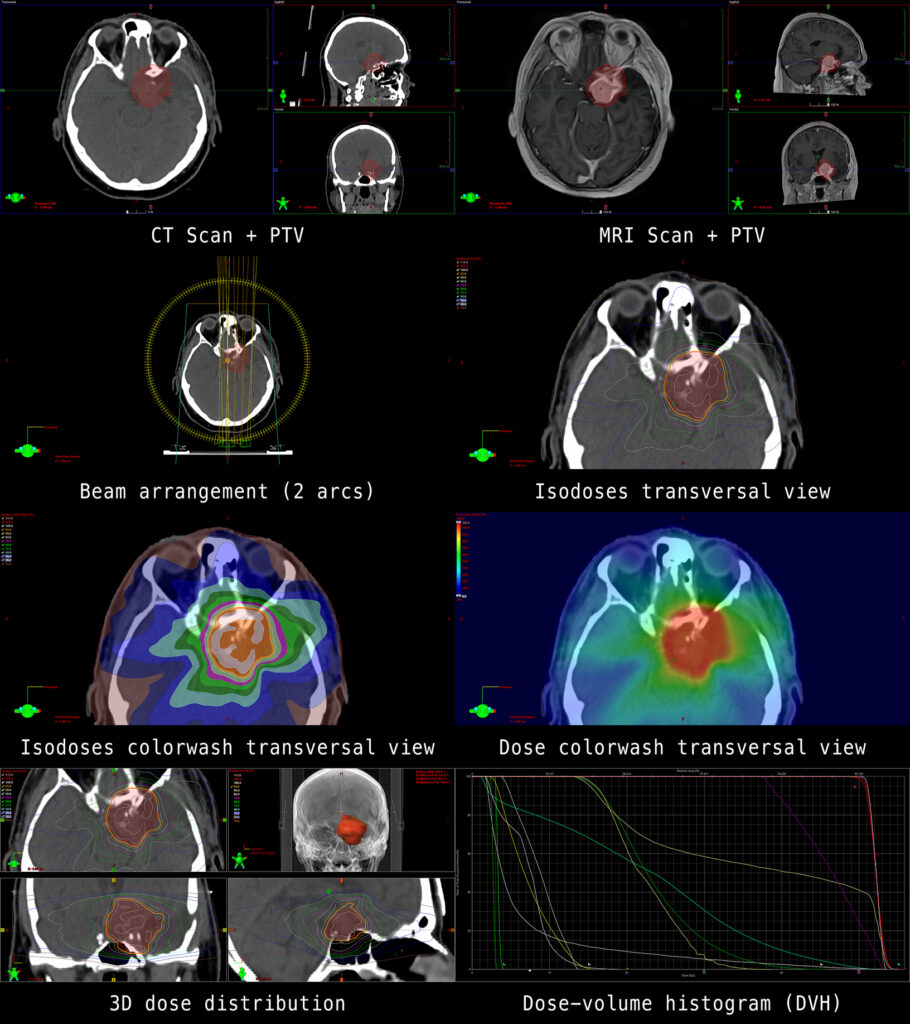 Imaging enhances tumour targeting accuracy in precision radiation therapy planning
