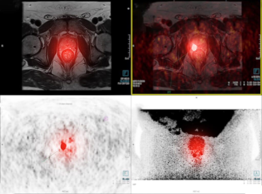 Modern approaches to prostate cancer treatment improve outcomes through personalised care