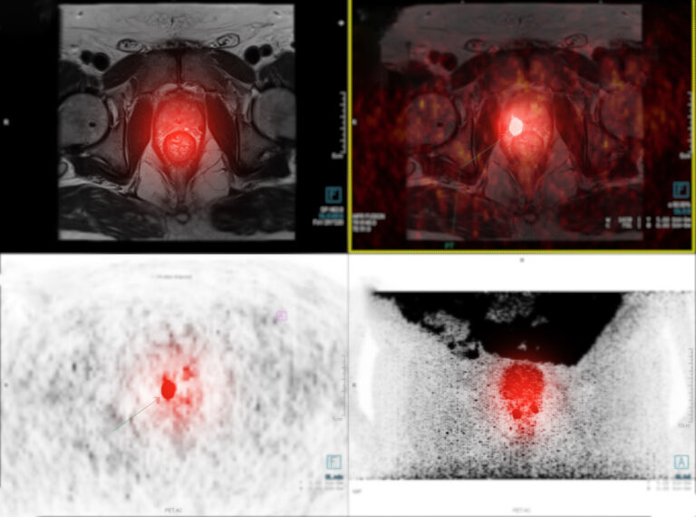 Modern approaches to prostate cancer treatment improve outcomes through personalised care