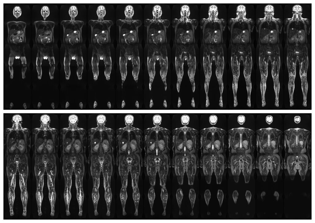 Quantitative Whole-Body MRI provides comprehensive, non-invasive, system-wide diagnostic insights