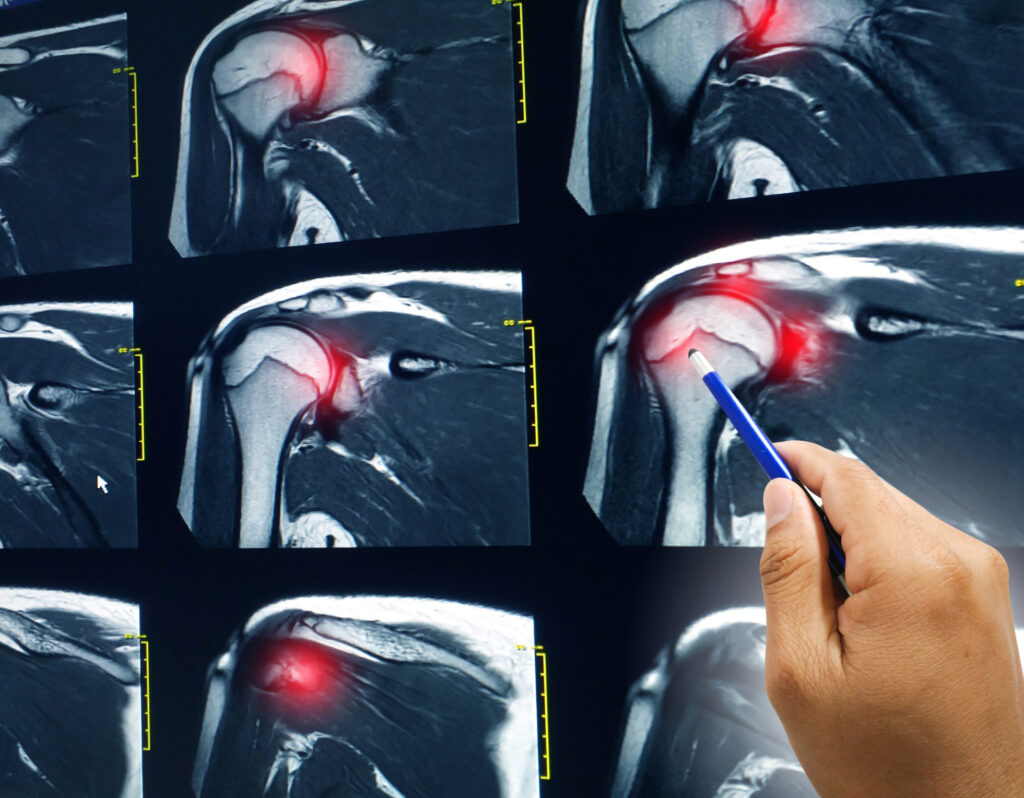 Rotator cuff repair surgery restores shoulder function and reduces pain
