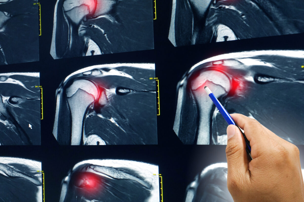 Rotator cuff repair surgery restores shoulder function and reduces pain