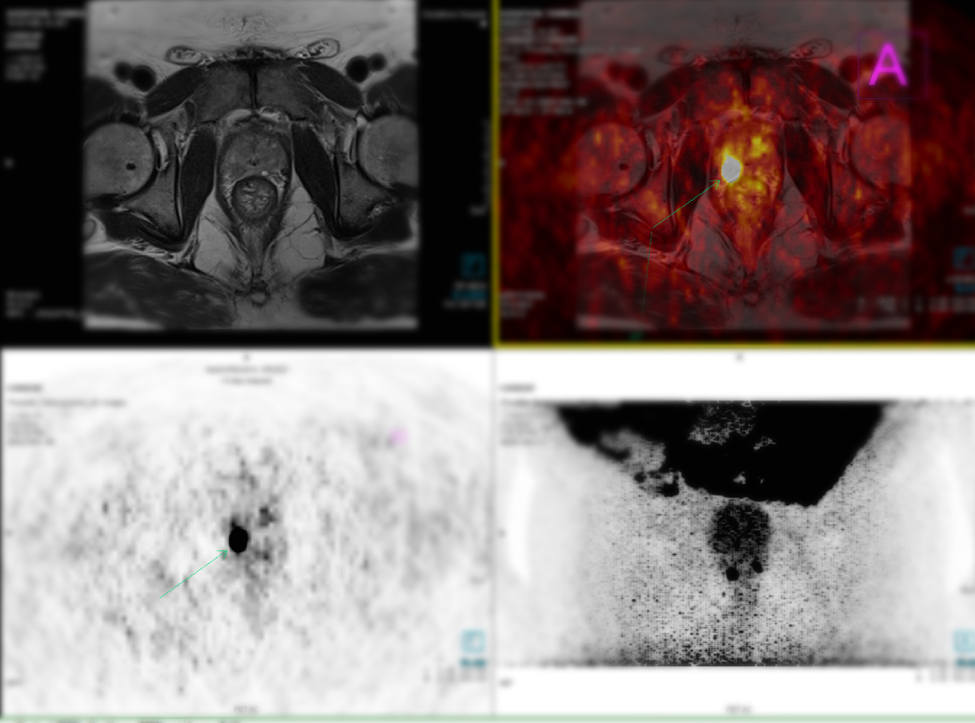 Gozetotide approval transforms prostate cancer diagnosis with precise PET imaging
