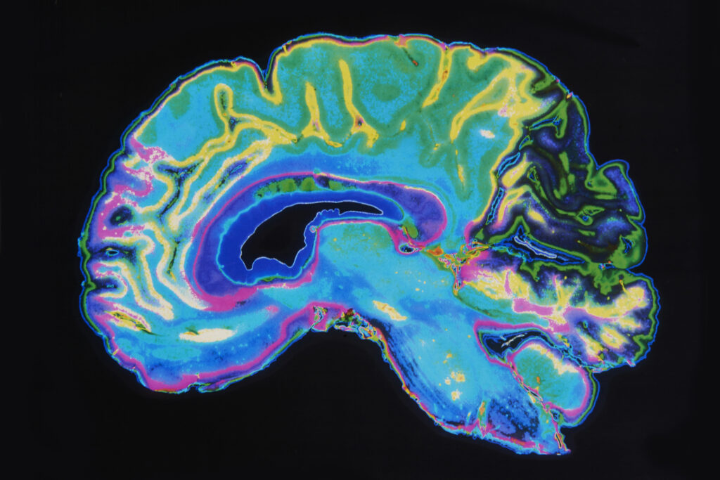 The theory behind magnetic resonance imaging involves nuclear spin interactions