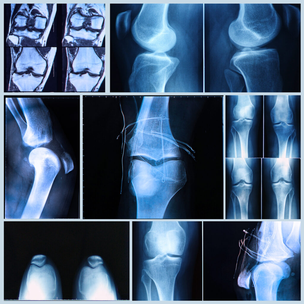 Unreported injuries complicate personal injury settlements by weakening evidence and timelines