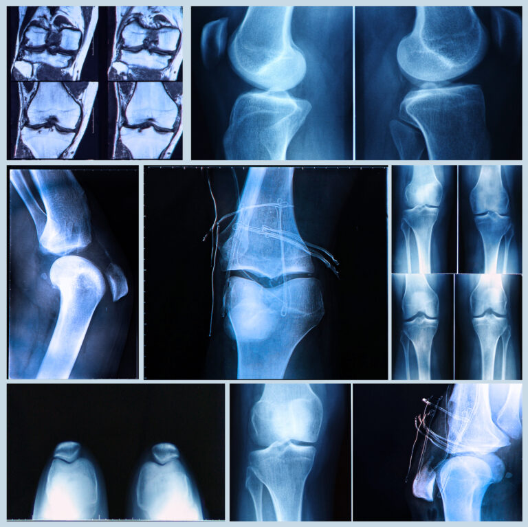 Unreported injuries complicate personal injury settlements by weakening evidence and timelines