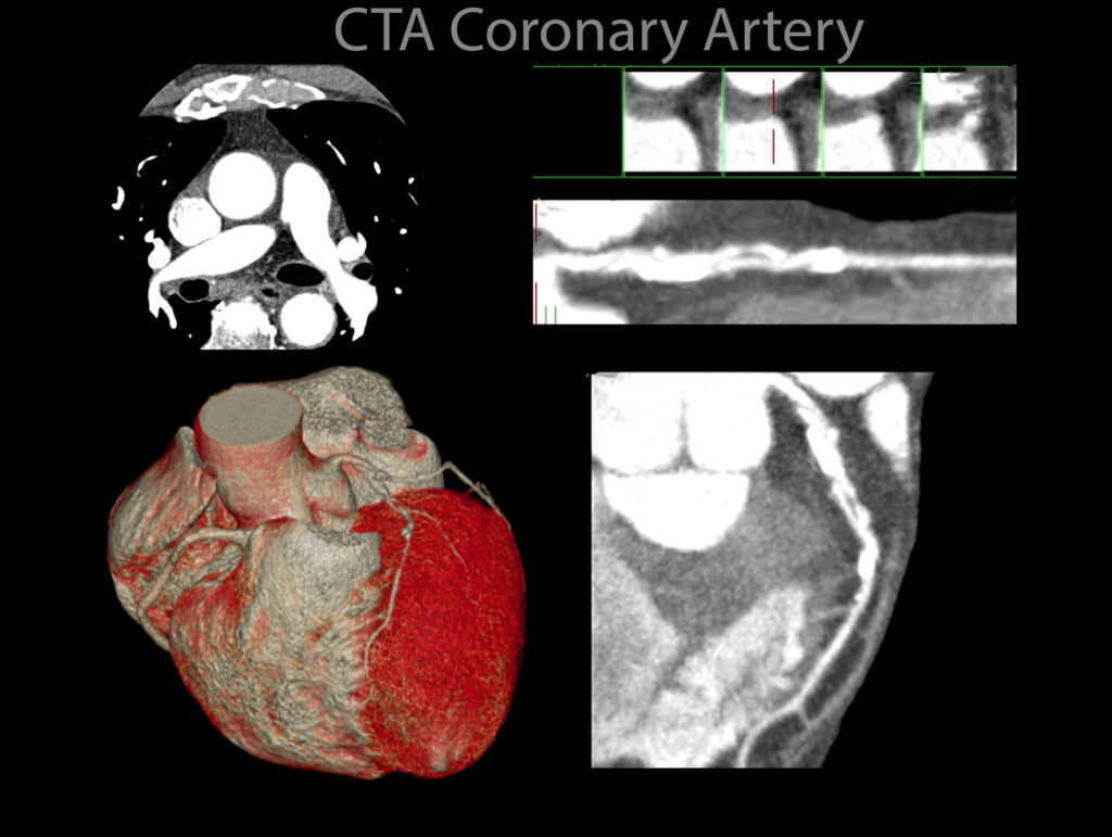 AI-derived FFR-CT improves cardiac diagnostics and efficiency across the NHS
