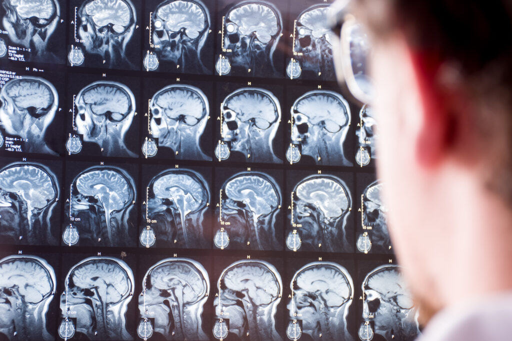 Breath-hold fMRI detects subtle cerebrovascular changes after mild traumatic brain injury