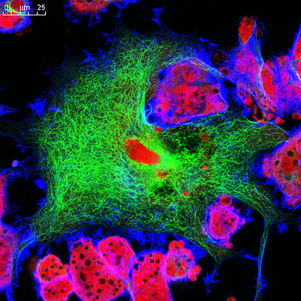Baseline PET/CT aids prognosis in rare congenital neuroblastoma cases