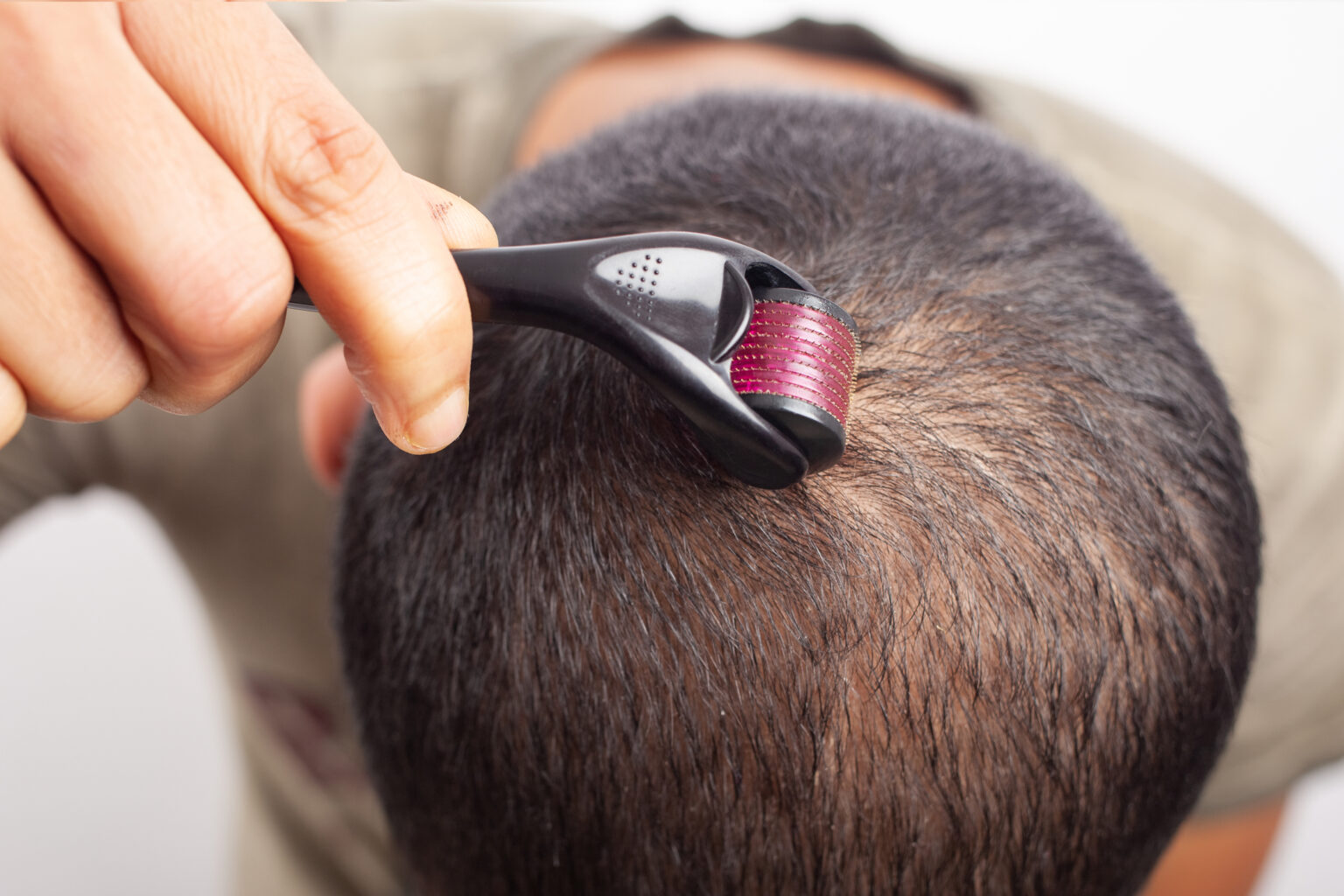 Microneedling for hair loss really works when used consistently and correctly.