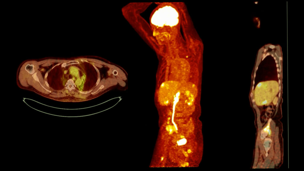 PET imaging in practice reveals functional activity, guiding accurate clinical decisions