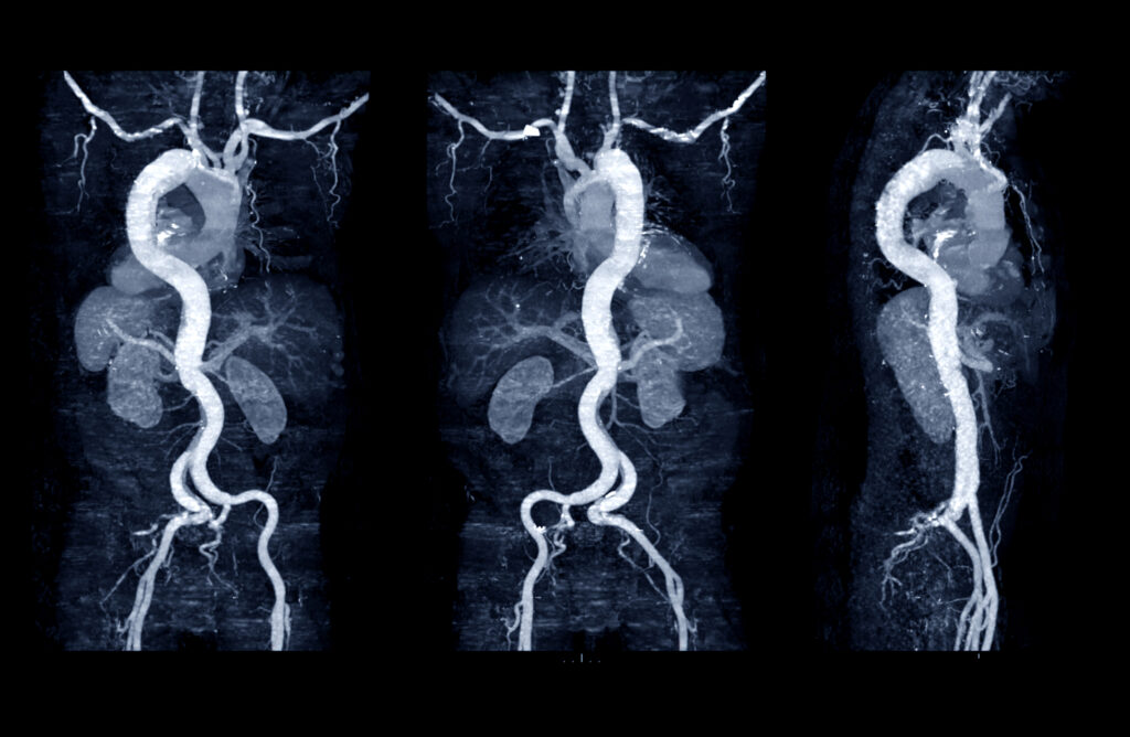 Perivascular fat density on CTA predicts abdominal aortic aneurysm progression