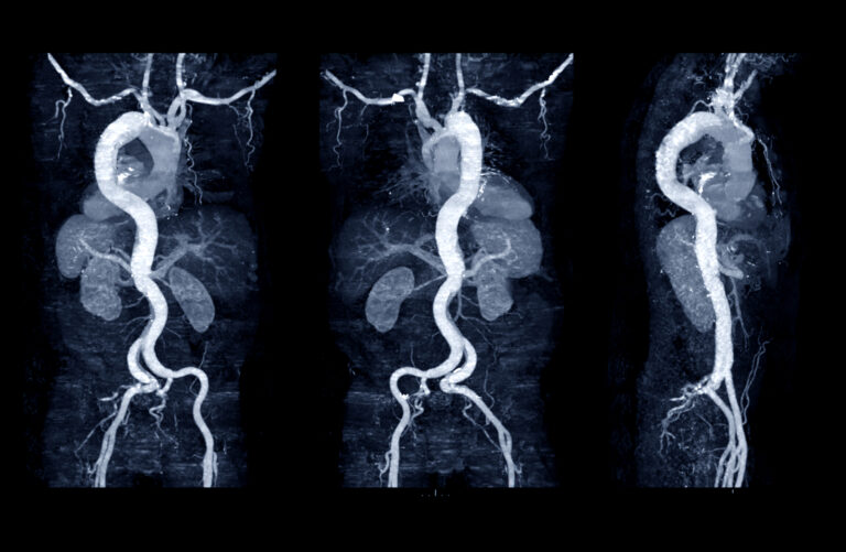 Perivascular fat density on CTA predicts abdominal aortic aneurysm progression