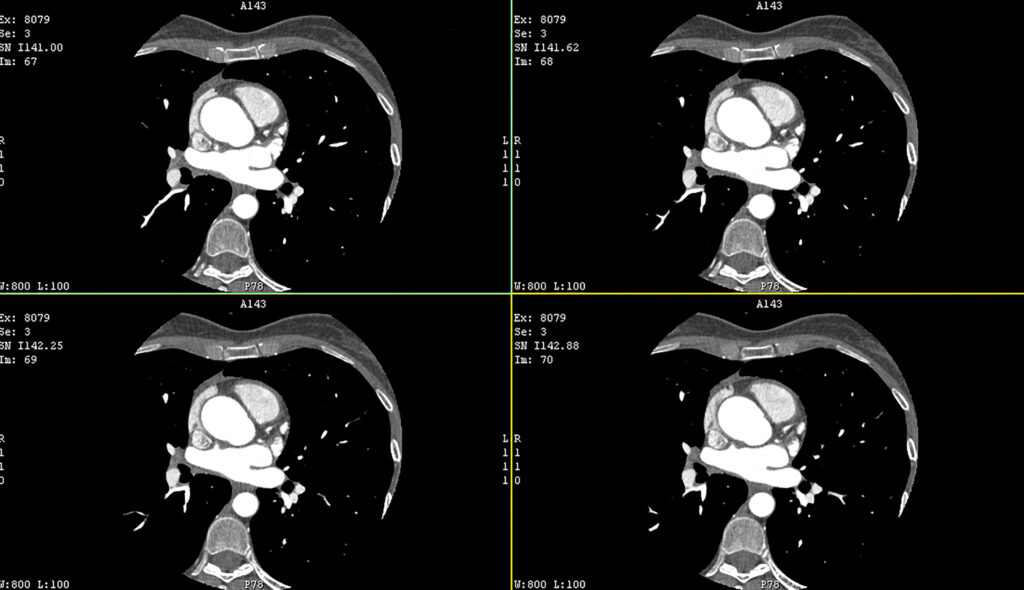 Photon-counting CT enables accurate, detailed myocardial mapping for cardiac disease assessment