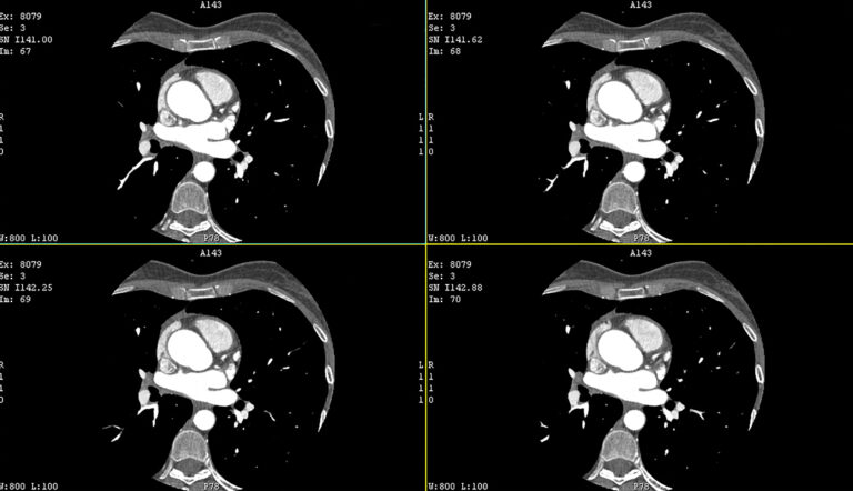 Photon-counting CT enables accurate, detailed myocardial mapping for cardiac disease assessment