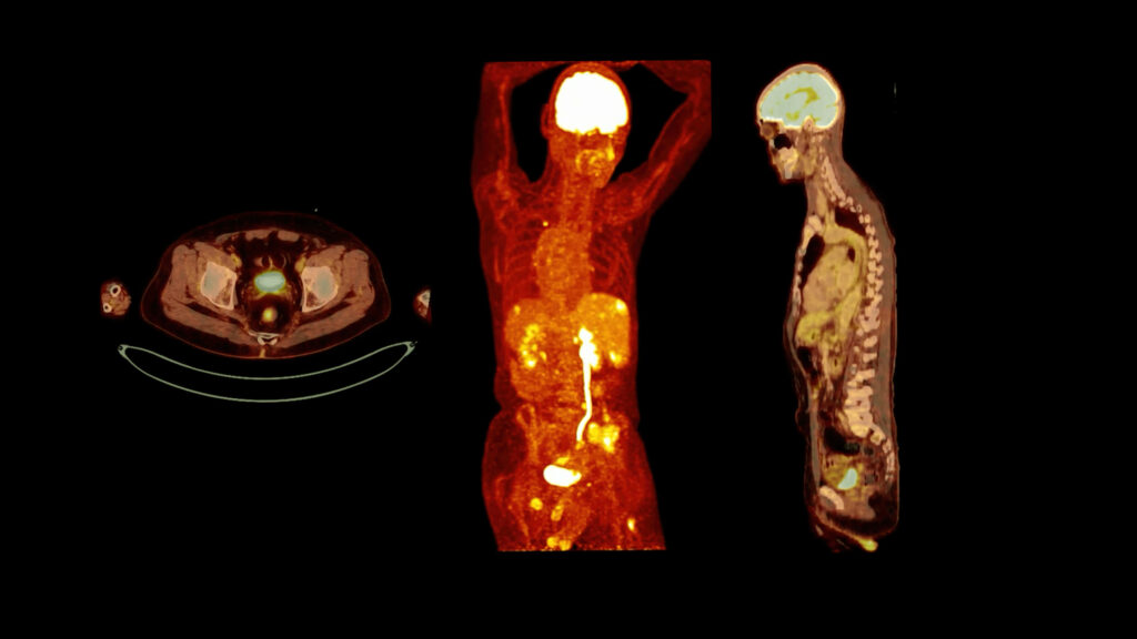 A groundbreaking total-body scanner arrives in Edinburgh, revolutionising medical imaging