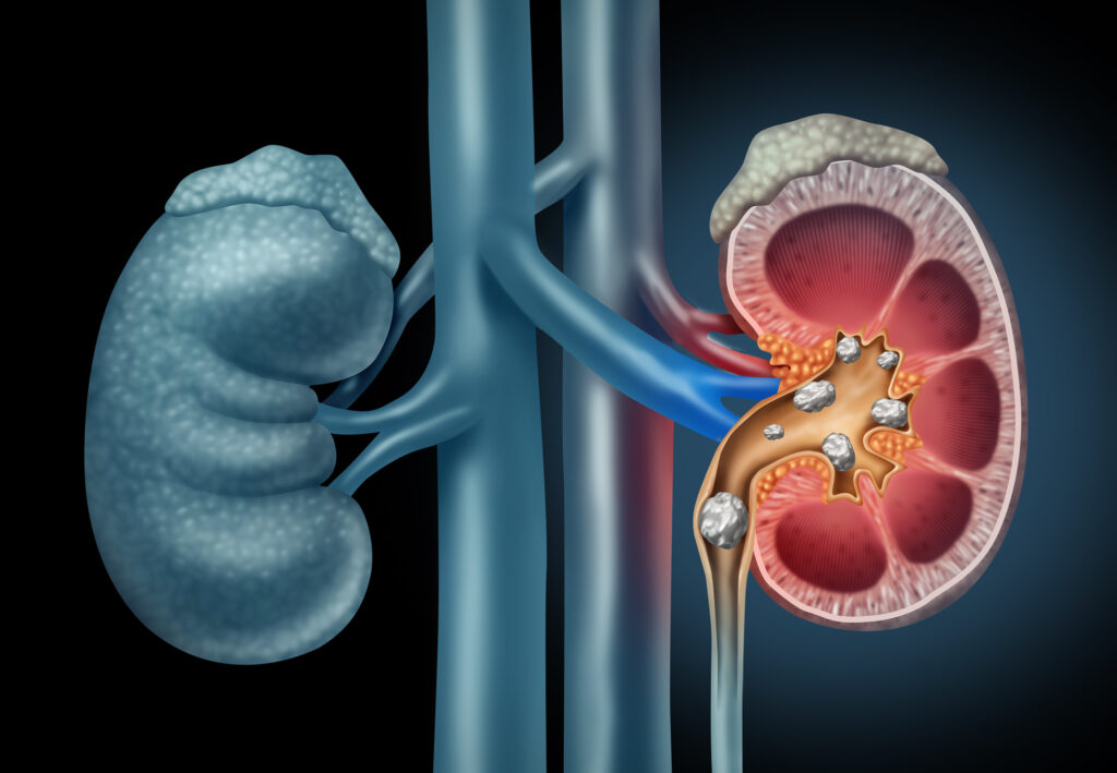 Urolithiasis risk factors include diet, genetics, hydration, and medical conditions