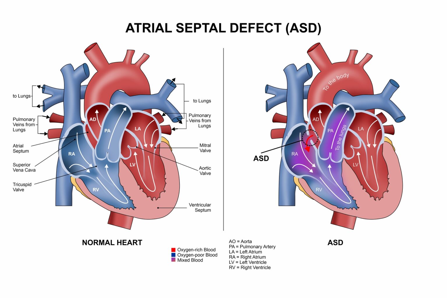 Adults with atrial septal defect often experience fatigue, breathlessness, palpitations