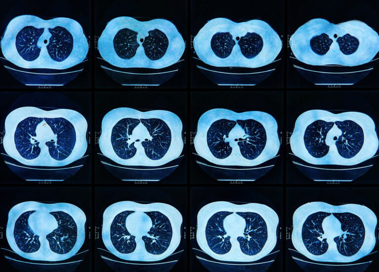 AI-powered low-field MRI dramatically improves global access to advanced lung imaging