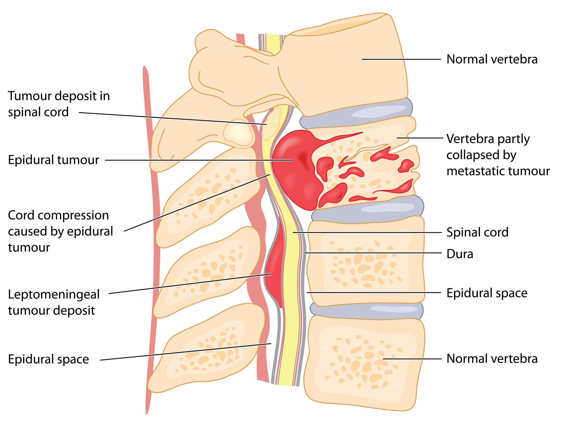MRI technology revolutionises the detection and diagnosis of spinal cord tumours