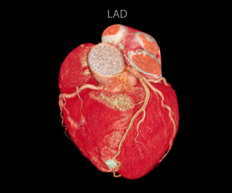 Magnetic Resonance Angiography provides detailed imaging, improving aortic disease diagnosis accuracy