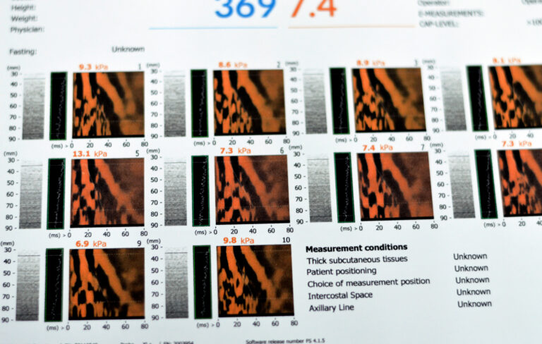 Ultrasound elastography accurately measures liver fibrosis in chronic liver disease