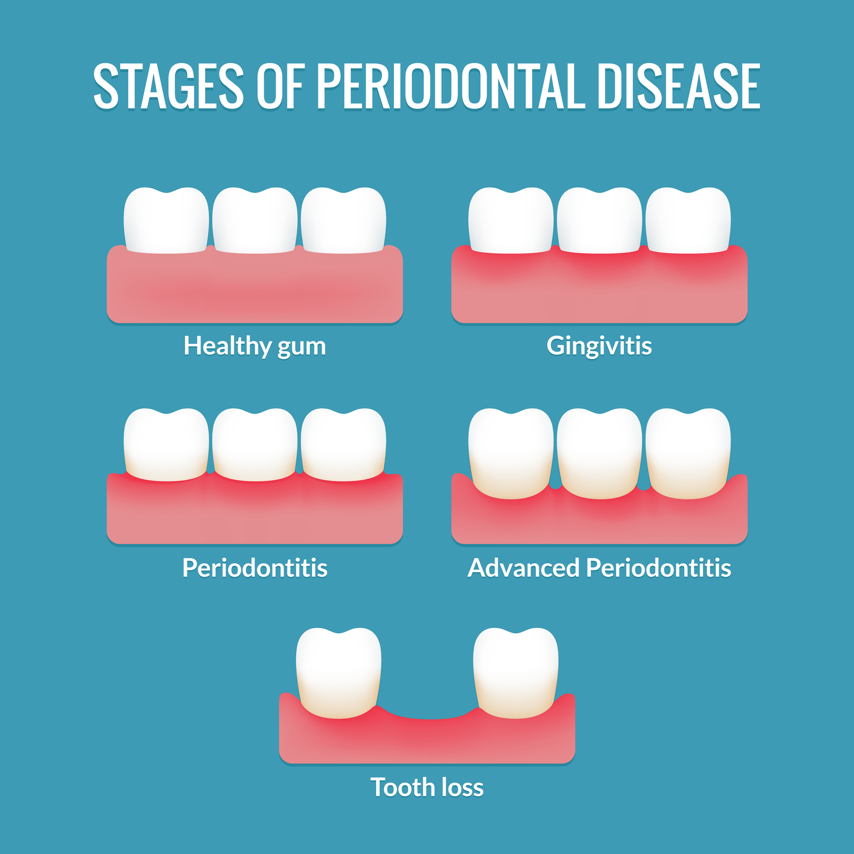 Maintaining healthy gums requires daily brushing, flossing, and regular dental check-ups
