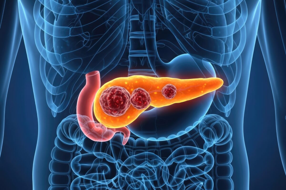 Pancreatic cancer research in 2025 accelerates detection and treatment innovation
