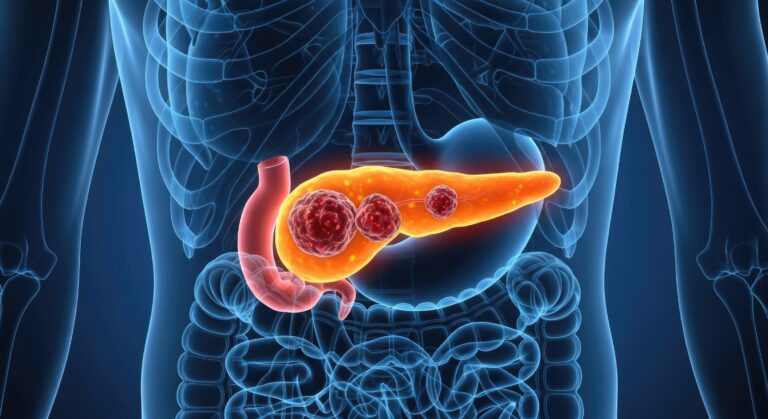 Pancreatic cancer research in 2025 accelerates detection and treatment innovation