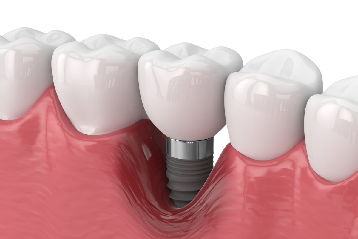 Peri-implant mucositis causes gum inflammation around implants, requiring early professional treatment