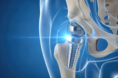 Precision in hip replacement surgery improves outcomes, mobility, safety, durability