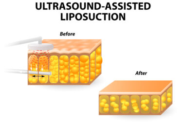More people explore liposuction options seeking confidence, comfort, better appearance