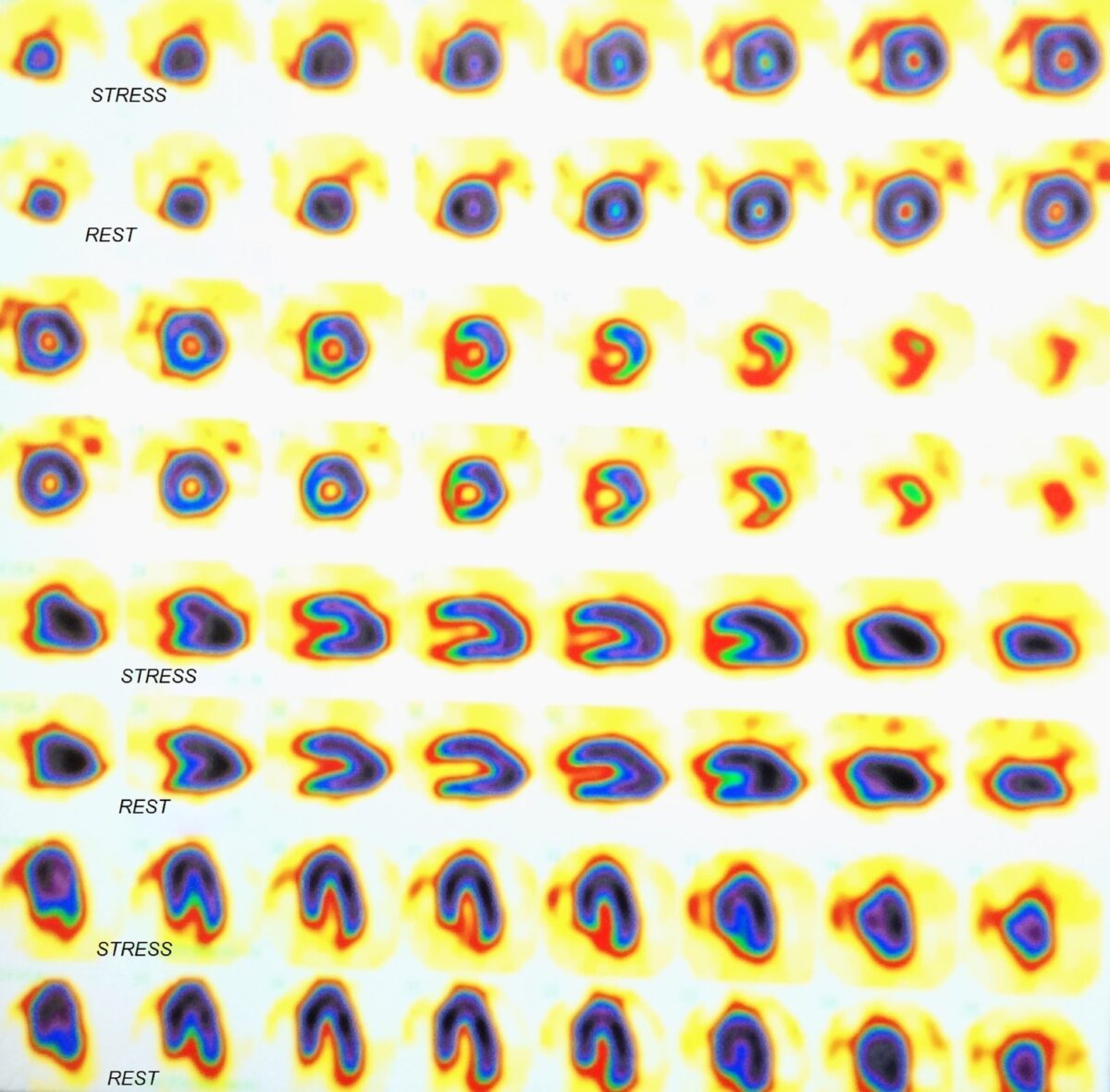 Nuclear myocardial perfusion stress test images reveal cardiac ischaemia