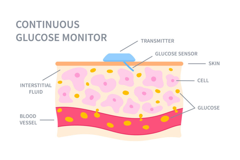 Continuous Glucose Monitoring improves control yet carries risks
