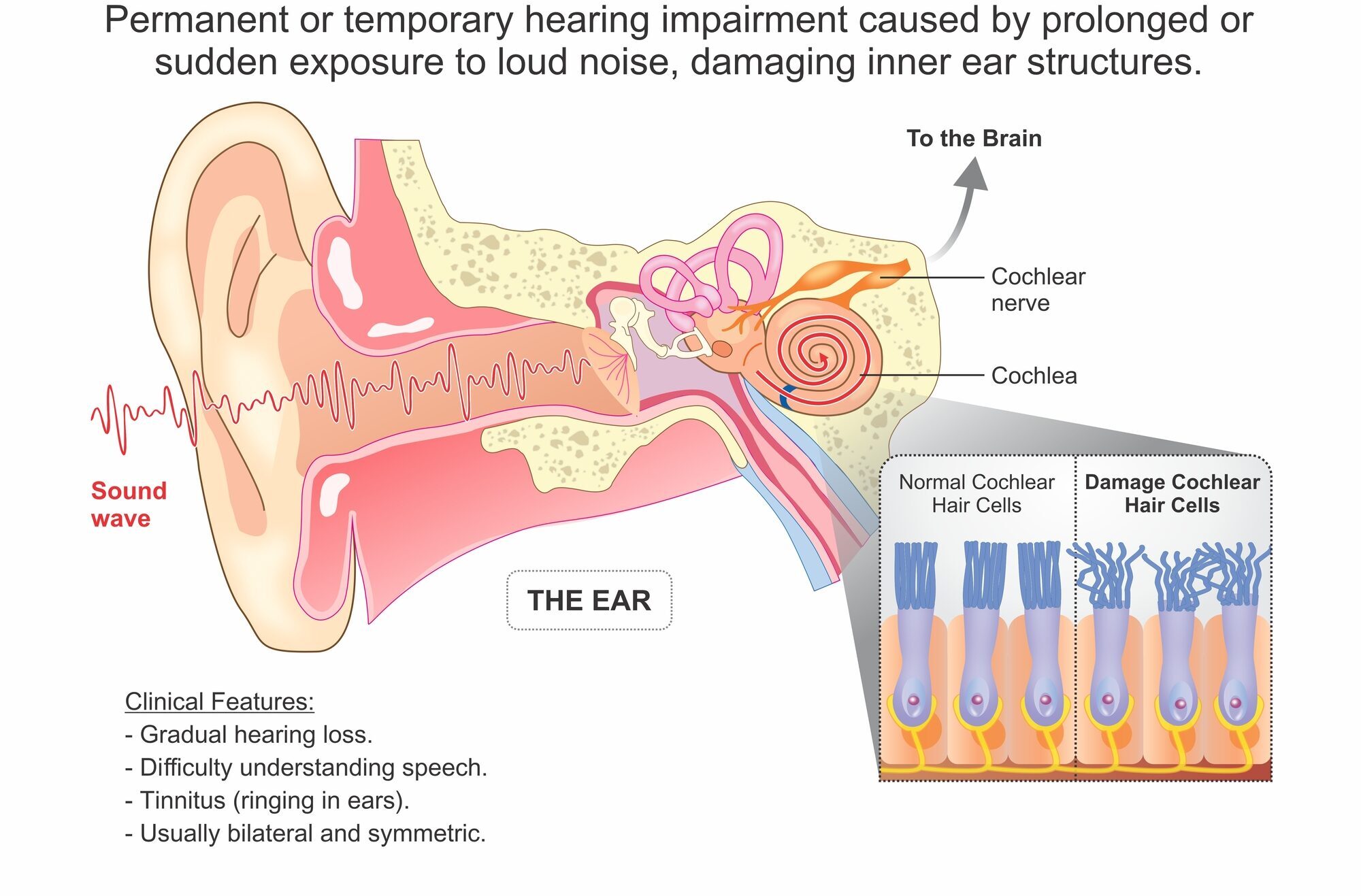 Sudden hearing loss can strike unexpectedly and needs urgent medical attention