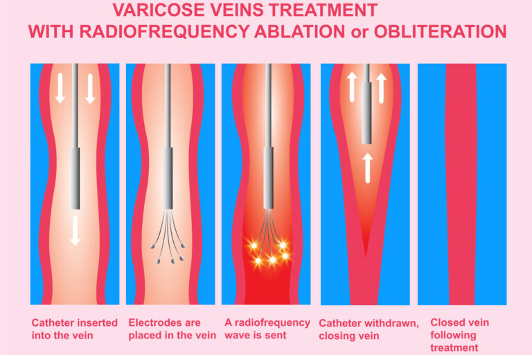 Modern science is transforming varicose vein treatment for patients worldwide