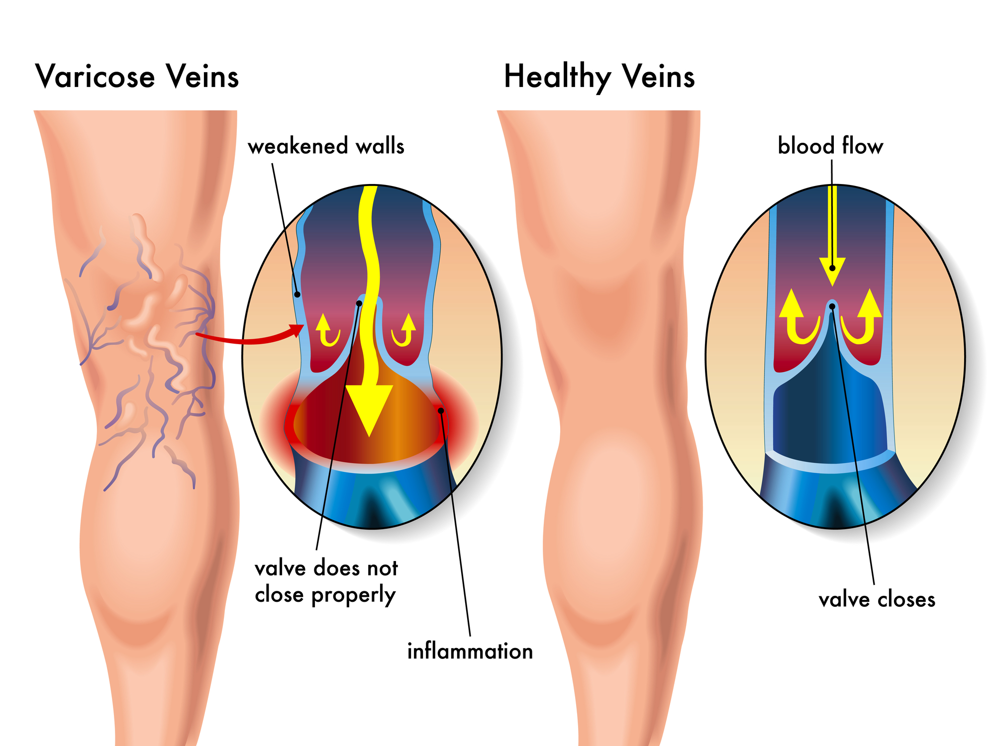Persistent leg swelling, pain, and visible veins suggest specialist care