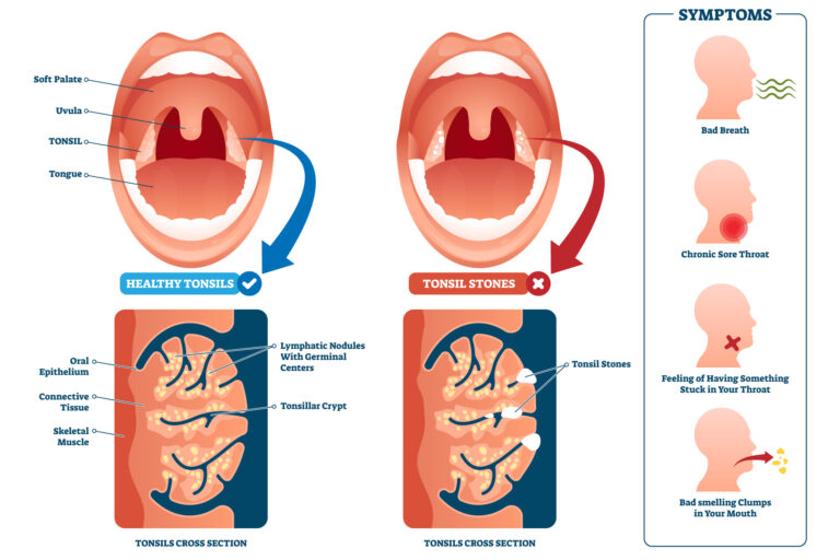 Tonsil stones form when debris, bacteria, mucus, and cells calcify
