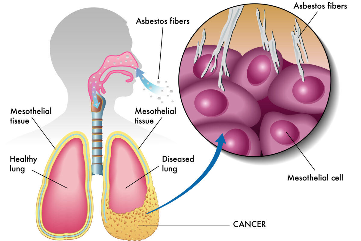 Medical imaging helps detect and stage mesothelioma earlier for treatment