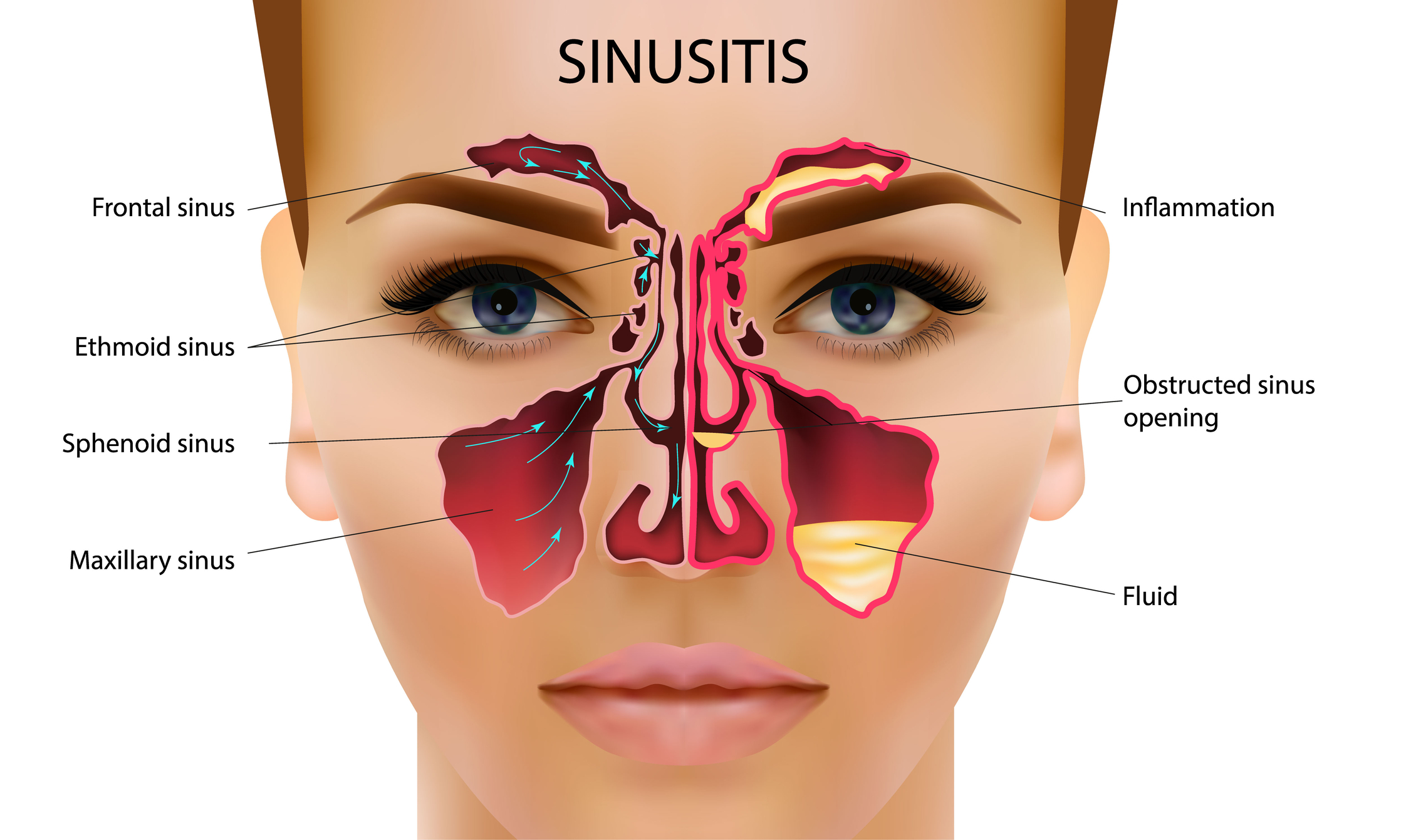 Sinus headache treatment reduces recurring facial pressure through targeted care